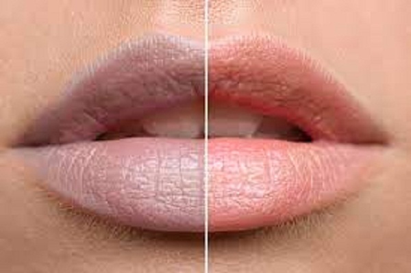 8 food varieties to assist you with disposing of dim lips