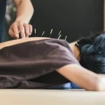 Acupuncture: A Comprehensive Guide