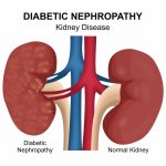 Diabetic Nephropathy: Causes, Symptoms, and Treatment Options